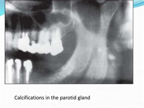 Soft Tissue Calcification Of Head And Neck Ppt