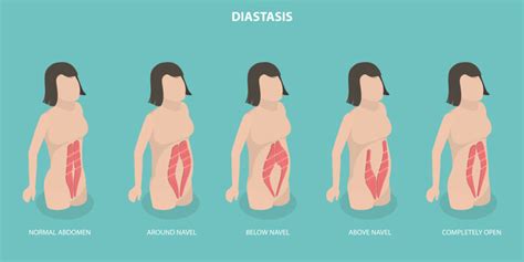 Diastasis Recti Causes Symptoms And Treatment Gulfphysio Uaes