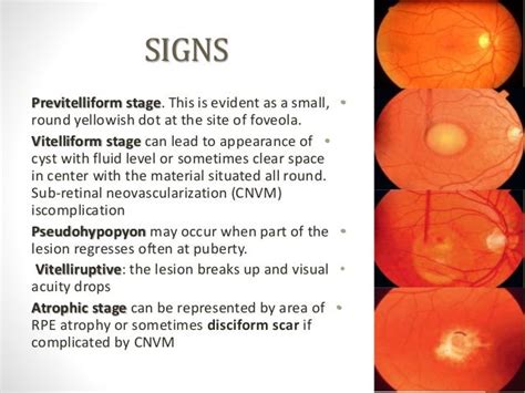 Macular Disorders Best Disease