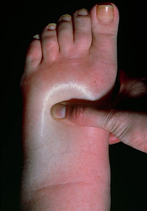 Swollen Foot Showing Pitting Oedema Photograph By Science Photo Library