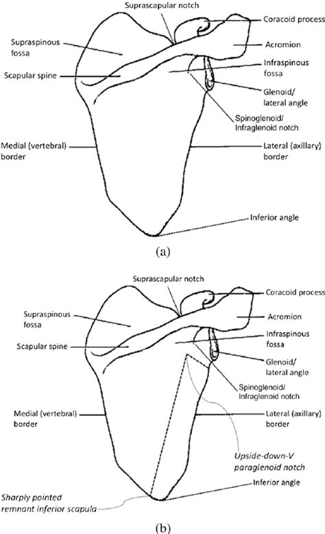 A Normal Scapular Anatomy B Scapular Anatomy With Superimposed