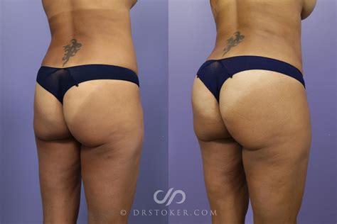 Brazilian Butt Lift Before And After Jawersharp