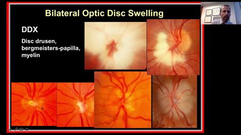 Approach To The Patient With Bilateral Optic Disc Swelling Youtube