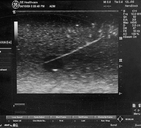 Ultrasound Image During Needle Placement Download Scientific Diagram