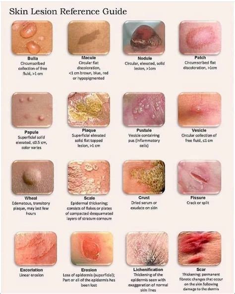 Primary Skin Lesions Chart