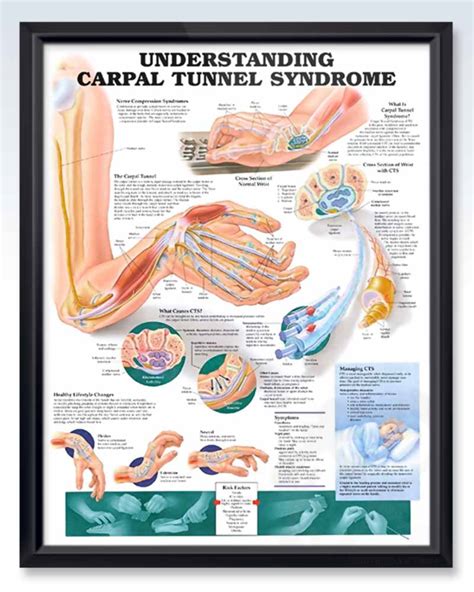 Carpal Tunnel Syndrome Anatomy Poster Clinicalposters