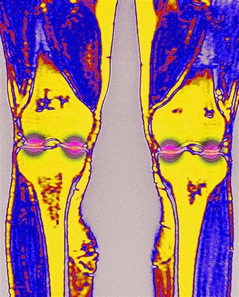 Common Joint Pain Treatment May Be Making Arthritis Worse Studies