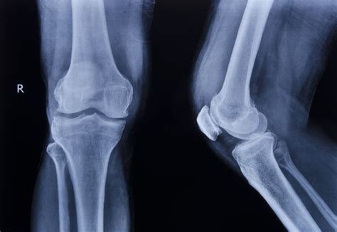 Ai Tool Narrows Pain Disparity For Black Patients With Knee
