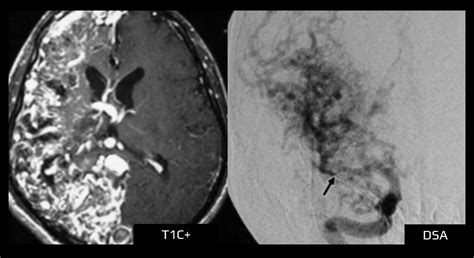 Cerebral Arteriovenous Malformation Avm Stroke Manual