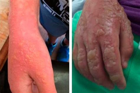 Highly Toxic Hogweed Plant Leaves Children With Horrific Burns And