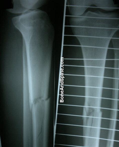 Xray Pictures Of Fractured Tibia Bone And Spine