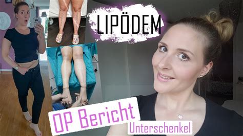 Lipödem Op Bericht Meine Unterschenkel Op Lipoclinic Teil 1