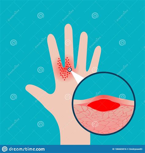 Eczema Dermatology Concept Stock Vector Illustration Of Care 186665816