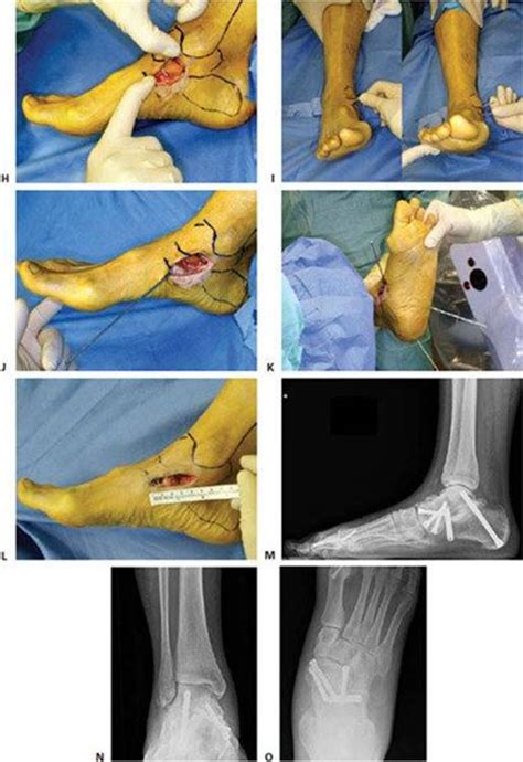 Medial Ankle Deltoid Ligament Reconstruction Foot And Ankle Free