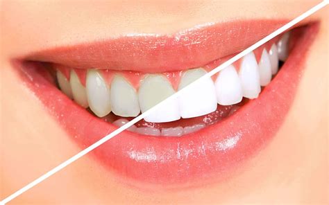 Teeth Whitening Fivecorner
