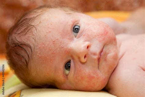 Newborn Baby On Face Rash Acne Neonatorum Stock Photo Adobe Stock