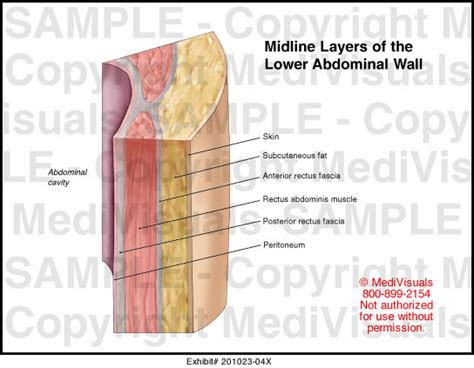 Midline Layers Of The Lower Abdominal Wall Medical Exhibit