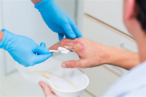 Nurse Is Taking Care Of Patient With Burn On His Hand Stock Photo