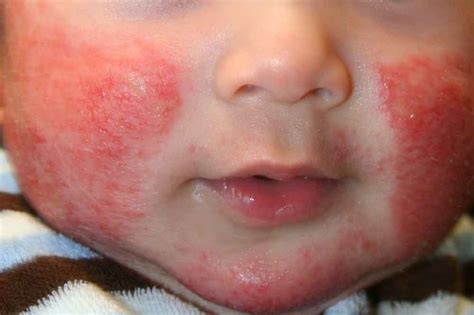 Dermatitis Atópica En El Bebé Baby Suite By Pau