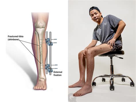 Leg Lengthening Surgery Takes The World By Storm