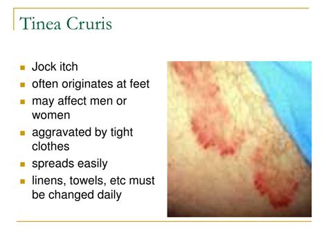 Jock Itch Tinea Cruris Dermatological Diseases Hot Sex Picture
