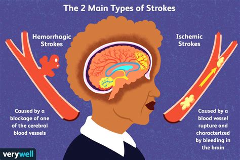 Stroke Explained Causes Types Pathophysiology And Complication Sexiz Pix