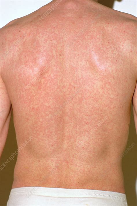 Eczema On The Back Stock Image C0404487 Science Photo Library