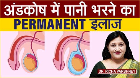 Hydrocele Treatment Home Remedy Swollen Testicles Causes अंडकोष