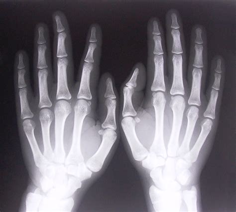 обои Руки Кости Рентгеновские лучи 1800x1617 Masklrx 1950703