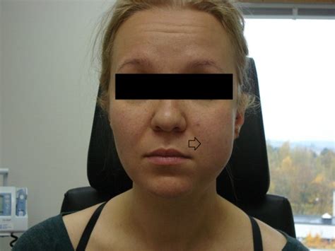 On The First Postoperative Day The Left Side Of The Patients Face Was