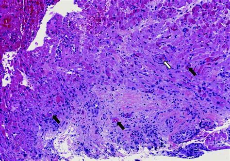Histology Of Endomyocardial Biopsy With Hematoxylin And Eosin Stain