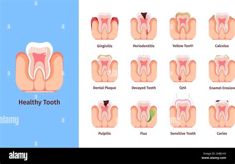 Teeth Problems Medical Infographic Illustrations With Bad Commons