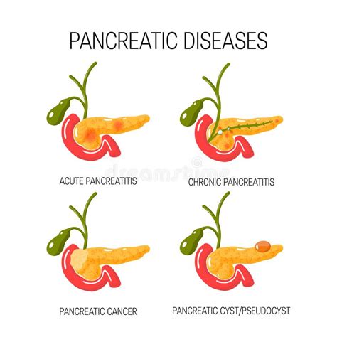 Chronic Pancreatitis Concept Vector Illustration Stock Vector