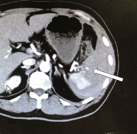 The Contrast Enhanced Computed Tomography Ct Scan Of The Abdomen