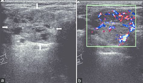 Thyroid Follicular Carcinoma Ultrasound