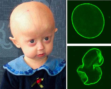 Progeria Causes Symptoms And Treatment Medical News Today