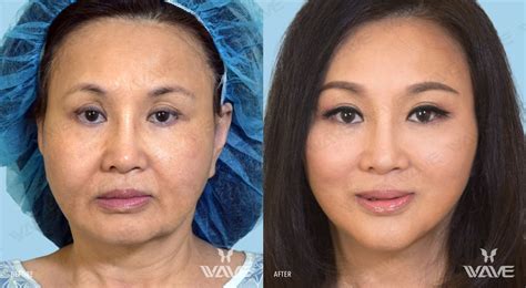 Wavelift Los Angeles Wave Plastic Surgery Anti Aging Cosmetics