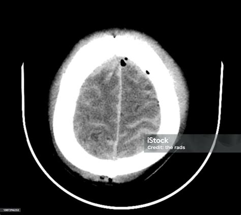 Traumatic Brain Injuries Ct Scan Image Stock Photo Download Image Now