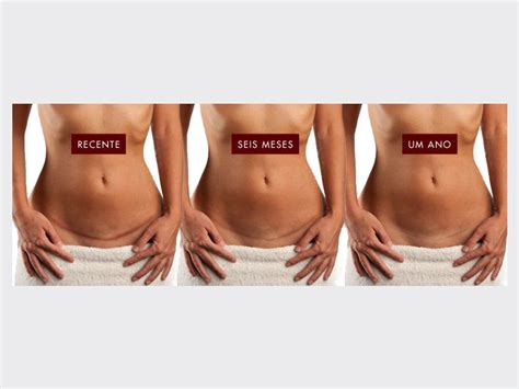 Aprender Sobre 31 Imagem Abdominoplastia Fotos Antes E Depois Cicatriz