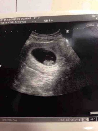What Does A 8 Week Scan Look Like Netmums Chat