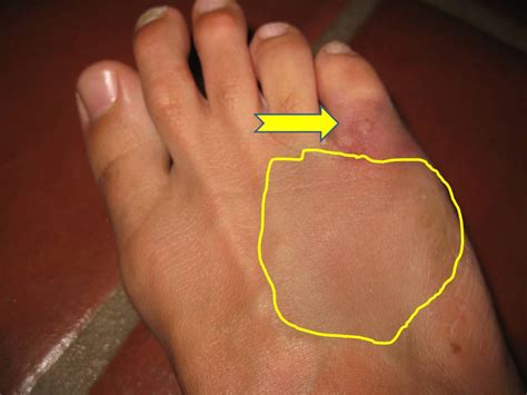 What Does A Broken Pinky Toe Look Like But It S Only A Broken Toe A