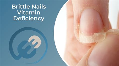 The Real Cause Of Brittle Nails Brittle Nails Vitamin Deficiency — Eating Enlightenment