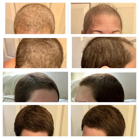 Top Image Hair Growth After Chemo Thptnganamst Edu Vn