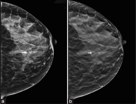 Breast Cancer Detection Now More Accurate With 3d Mammography Test
