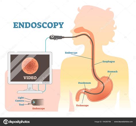 Sch Ma D Illustration Vectoriel Anatomique D Endoscopie Sch Ma M Dical