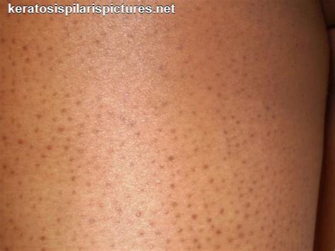 Home Treatment For Keratosis Pilaris Dorothee Padraig South West Skin