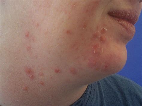 Causes And Treatments For Acne Papules