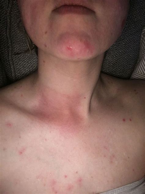 Thyroid Rash Neck Esther Wilkins Gossip