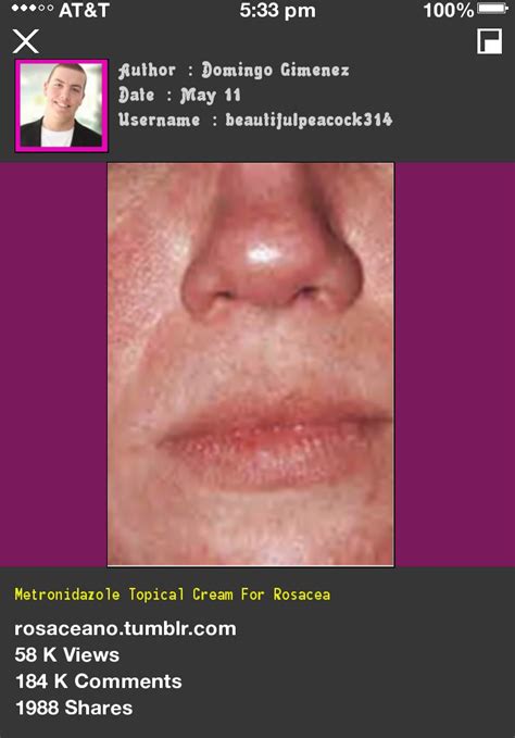 Dermoscent Essential 6 Side Effects - Metronidazole Topical Cream For Rosacea 085355 - Rosacea Free Forever.