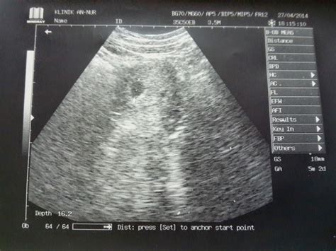 Beberapa janin tumbuh lebih cepat dari yang lain seperti pertumbuhann janin bulan pertama. yanaMz: Alhamdulilah, usia kandungan 6 minggu...